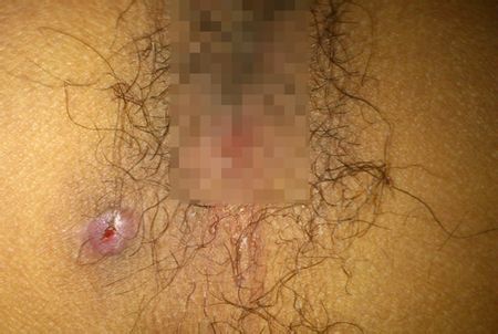 济南治肛瘘手术一般要多少钱