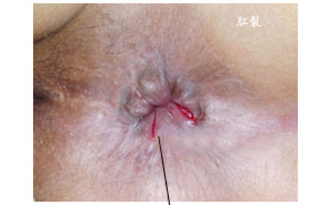 看肛裂去医院要挂什么科