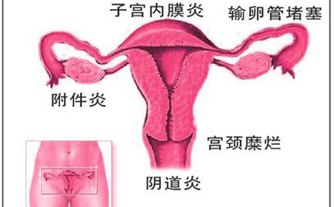 附件炎会导致不孕吗