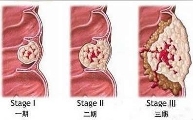 痔疮怎么治疗