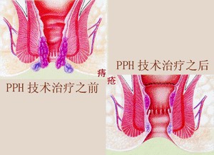 内痔出血有什么危害