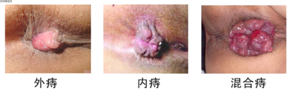 痔疮的图片和治疗方法