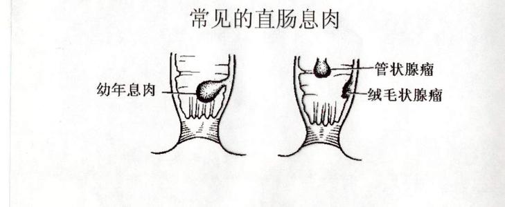 直肠息肉的症状有哪些