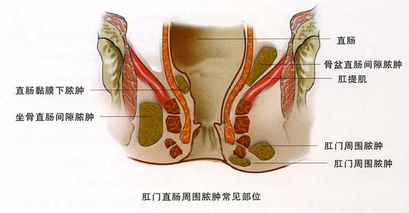 肛周脓肿不治有哪些危害
