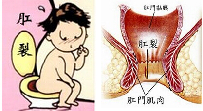 肛瘘自己能好起来吗