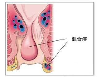 混合痔能自愈吗