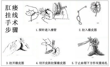 肛瘘图