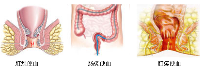 疼痛便血