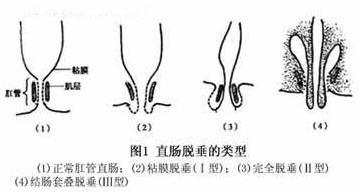 脱肛的症状